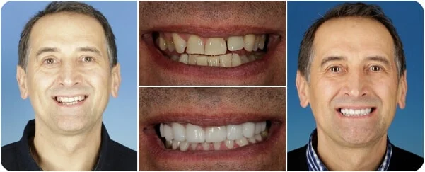 Full-arch implant before and after — actual patient of Dr. Lance Timmerman