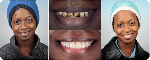 Cosmetic full-mouth rebuild — actual patient of Dr. Lance Timmerman