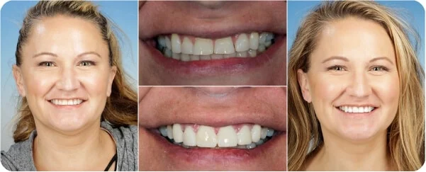 Smile makeover before and after — actual patient of Dr. Lance Timmerman