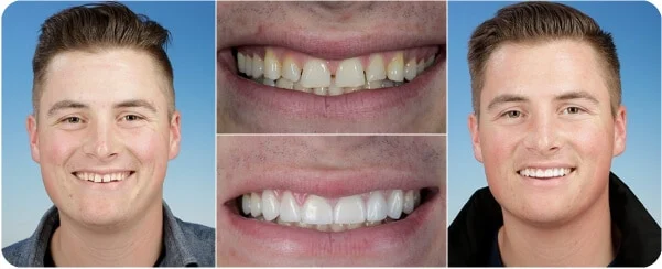 Anterior implant restoration before and after — actual patient of Dr. Lance Timmerman